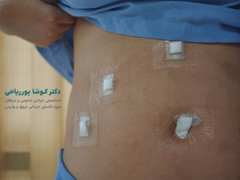 لاپاراسکوپی کیسه صفرا