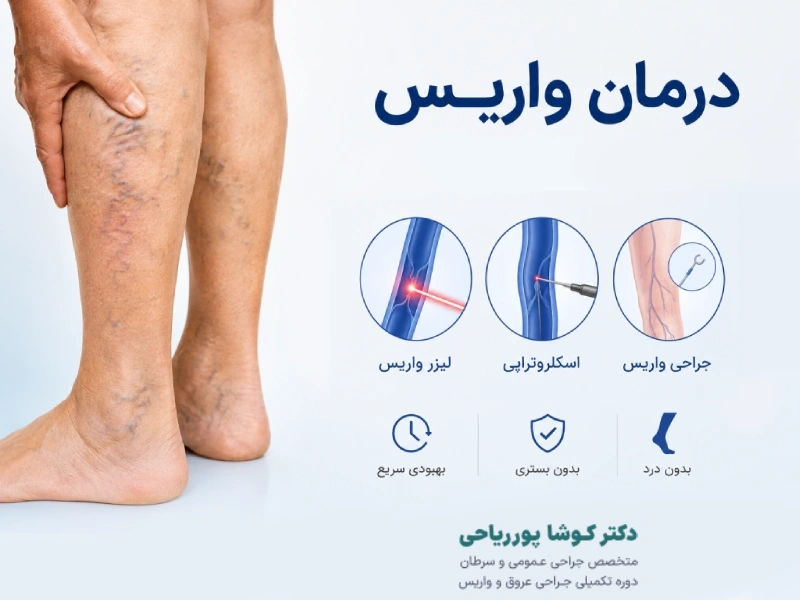درمان واریس اهواز