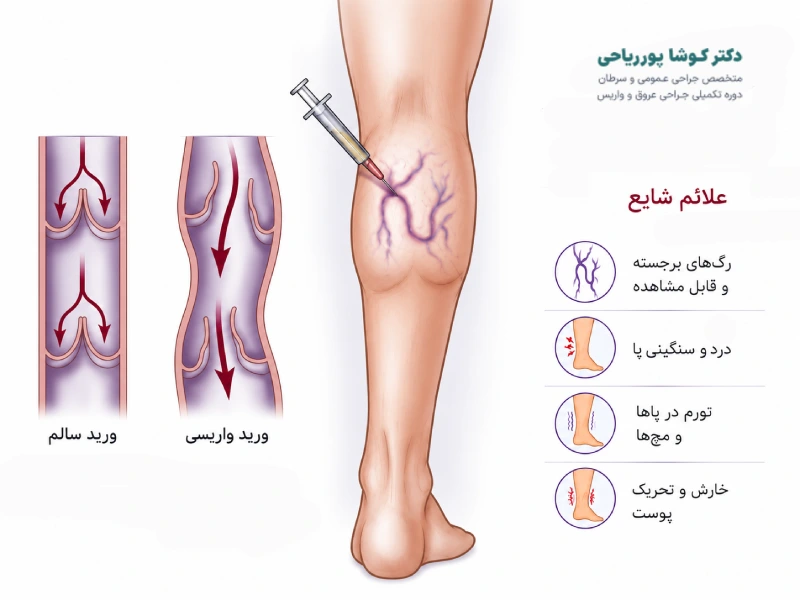 علائم واریس
