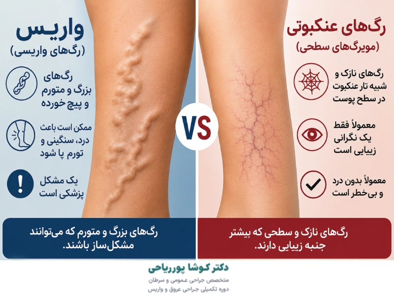 تفاوت رگ عنکبوتی و واریس