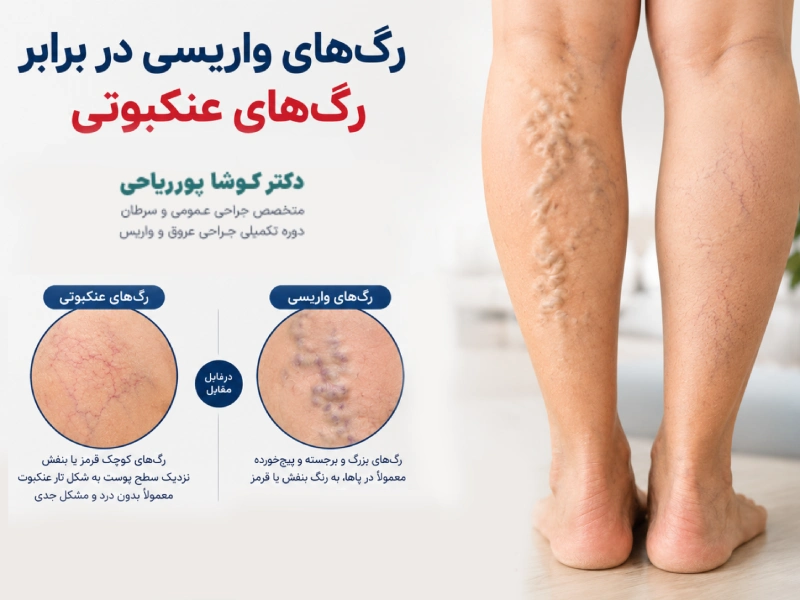 تفاوت واریس و رگ عنکبوتی