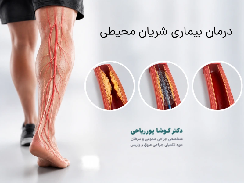 بیماری شریان محیطی