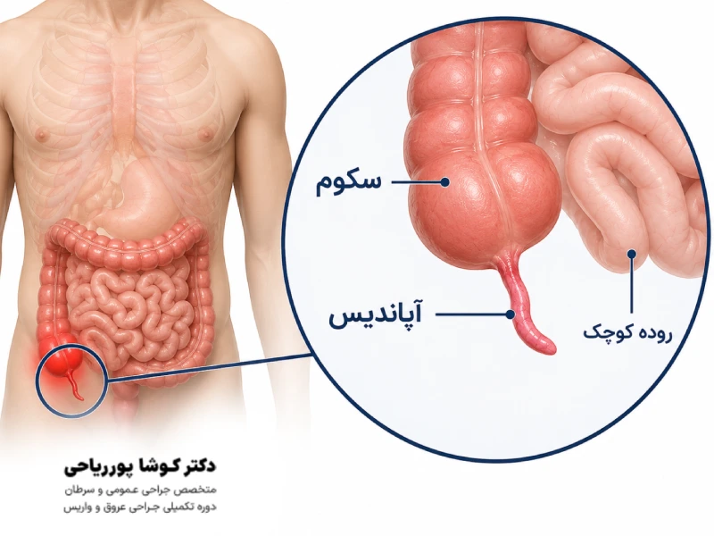 لاپاراسکوپی آپاندیس