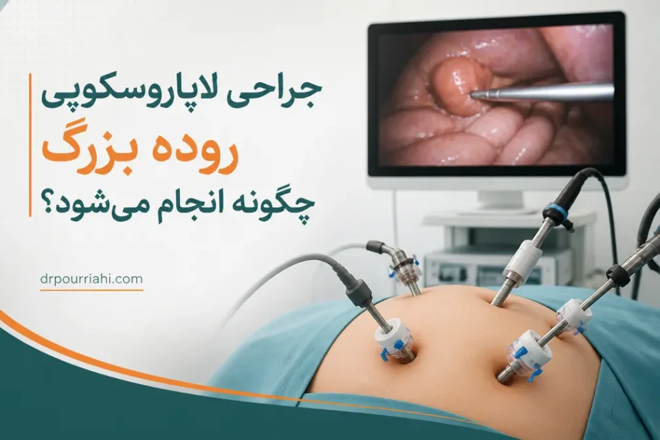 جراحی لاپاروسکوپی روده بزرگ چگونه انجام میشود — نمای آموزشی از نحوه انجام جراحی لاپاروسکوپی روده بزرگ با پورتهای کوچک و مانیتور