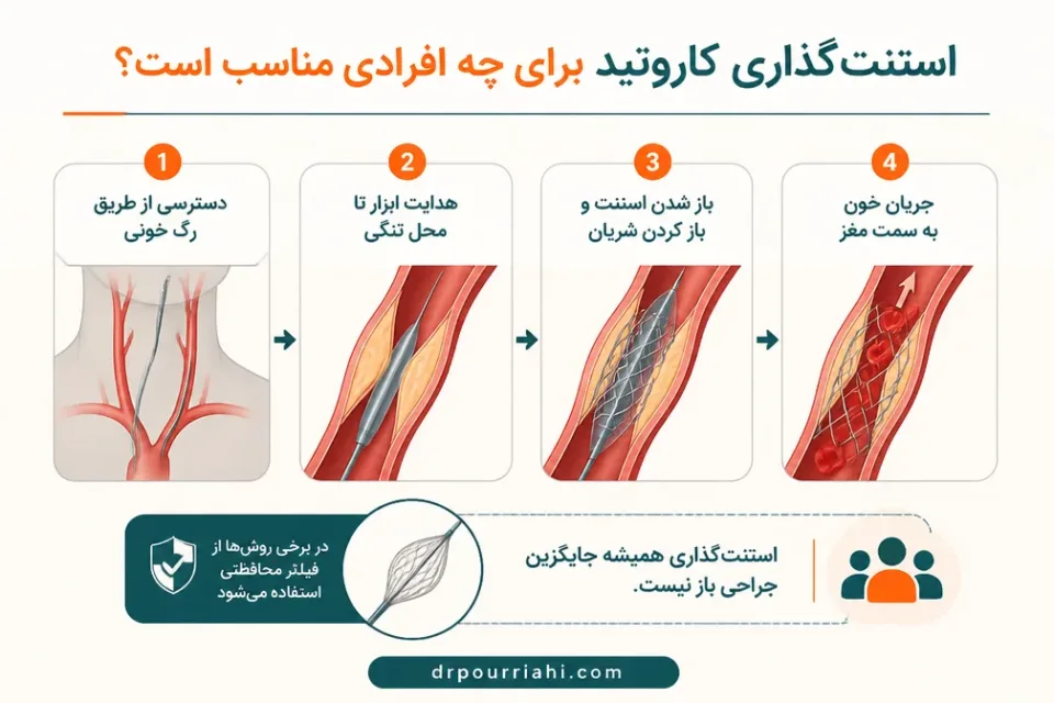 استنتگذاری کاروتید برای چه افرادی مناسب است — نمای شماتیک استنتگذاری برای درمان تنگی شریان کاروتید