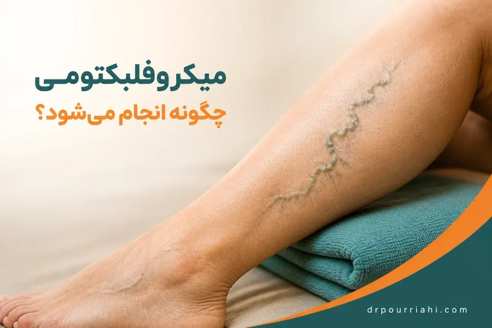 نمای نزدیک رگ واریسی سطحی روی ساق پا
